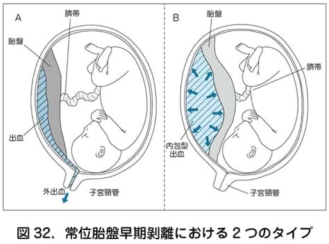 胎盤早期剝離 橫樑壓頂影響